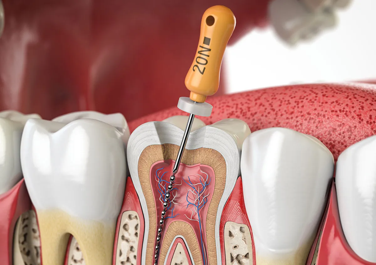 Endodontics category image
